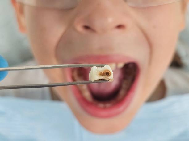 Best Emergency Dental Care for Broken or Chipped Teeth in Cohasset, MN